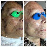 Microcurrent Face Lift After 2 Treatment
