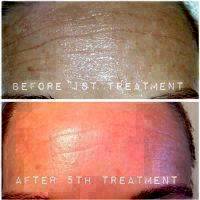 Microcurrent Face Lift After 5th Treatment