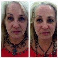 Microcurrent Face Lift Before And After Pictures (1)