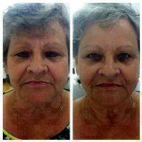 Microcurrent Face Lift Before And After Pictures (4)