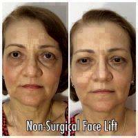 Microcurrent Face Lift Before And After Pictures (7)