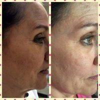 Microcurrent Face Lift Before And After Pictures (8)