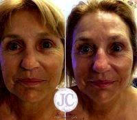 Microcurrent Facial Before After (5)