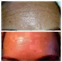Microcurrent Facial Before After (6)