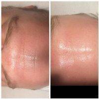 Microcurrent Facial Before After (9)