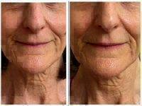 Microcurrent Facial Before And After Photos (2)
