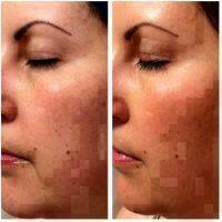 Microcurrent Facial Before And After Photos (4)