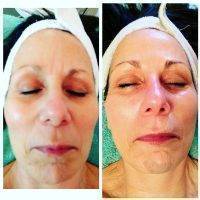 Microcurrent Facial Before And After Photos (7)