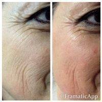 Microcurrent Facial Before And After Pictures (1)