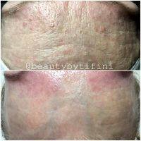 Microcurrent Facial Before And After Pictures (2)