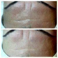 Microcurrent Facial Before And After Pictures (3)