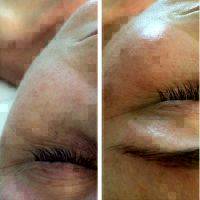 Microcurrent Facial Before And After Pictures (7)