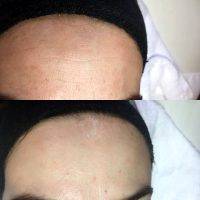 Microcurrent Facial Therapy Before And After (2)