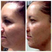 Microcurrent Facial Therapy Before And After (3)