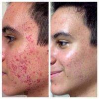 Microcurrent Facial Therapy Before And After (4)