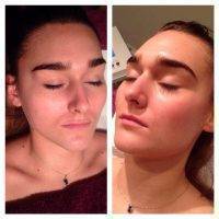 Microcurrent Facial Therapy Before And After (5)