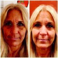 Microcurrent Facial Therapy Before And After Photo