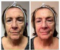 Microcurrent Facial Toning Before And After (2)
