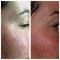 Microcurrent Facial Toning Before And After (3)