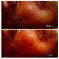 Microcurrent Facial Toning Before And After (4)