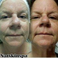 Microcurrent Facial Toning Before And After (5)