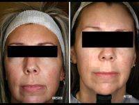 Microcurrent Facial Treatment Before And After (2)