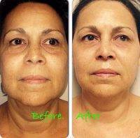 Microcurrent Facial Treatment Before And After (4)