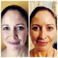 Microcurrent Facial Treatment Before And After (5)