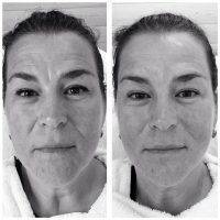 Microcurrent For Face Lift Photos (6)
