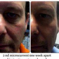 Microcurrent For Face Lift Photos (7)