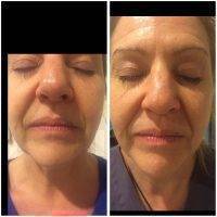 Microcurrent Galvanic Face Lift Before After Photos (1)