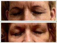 Microcurrent Galvanic Face Lift Before After Photos (5)