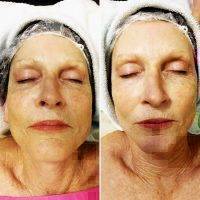 Microcurrent Galvanic Face Lift Before After Photos (6)