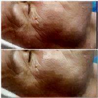 Microcurrent Therapy For Wrinkles Before And After