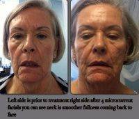Microcurrent Treatment Before And After (1)