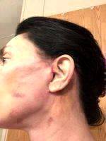 Mini Facelift Recovery Scars (11)
