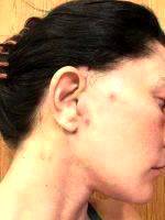 Mini Facelift Recovery Scars (12)