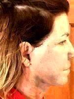 Mini Facelift Recovery Scars (4)