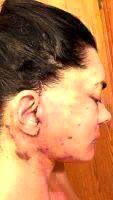 Mini Facelift Recovery Scars (8)