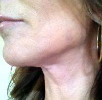 Mini Facelift Surgery Is The Most Common Type Of Facelift Surgery