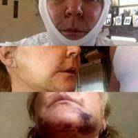 Minor Hematoma Facelift Pictures