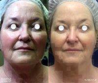 Nuface Microcurrent Facial Toning System Before After
