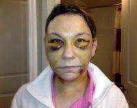 Photo Of Hematoma After Facelift Surgery