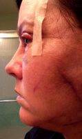 Pictures Of Lower Facelift Recovery (4)