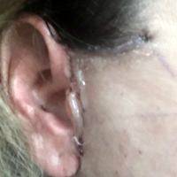 Pictures Of Scars After Lower Facelift (3)