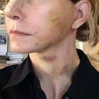 Post Facelift Bruising Pictures (4)