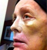 Post Facelift Bruising Pictures (5)