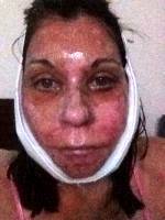 Post Facelift Bruising Pictures (7)