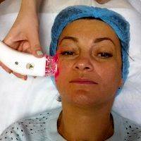 RF Facelift Is Commonly Used To Treat The Forehead, Under The Eyes, Cheeks