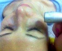 Radio Frequency Facelift At Home